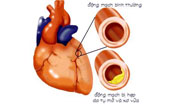 Bệnh đái tháo đường và cách phòng ngừa biến chứng tim mạch